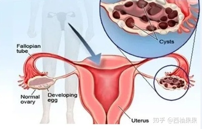 盆腔粘连能怀孕吗