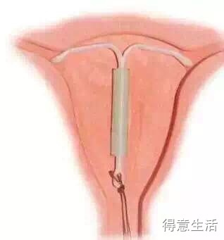 上环了腰疼是怎么回事