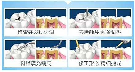 固化树脂补牙多少年