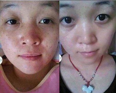 吃维生素e能去痘痘吗