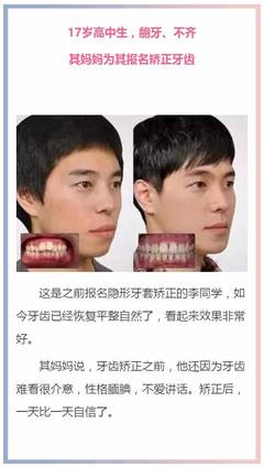 牙齿矫正时间要多久