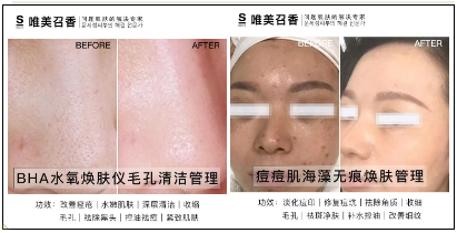 痘痘肌多久用一次清洁