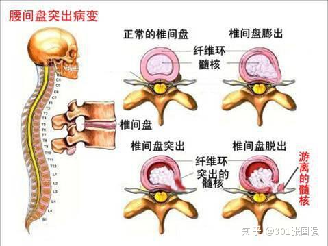 椎间盘膨突出怎么治疗