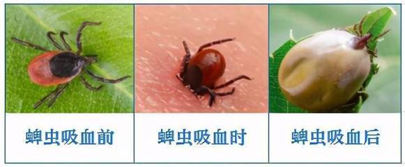 蜱虫咬人后怎么治疗