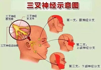 三叉神经疼是怎么回事