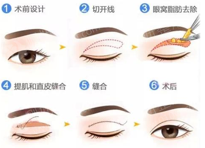 做完双眼皮的注意事项有哪些