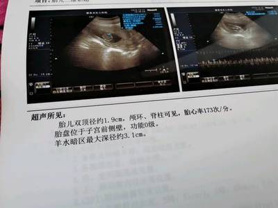 胎儿颅脑超声
