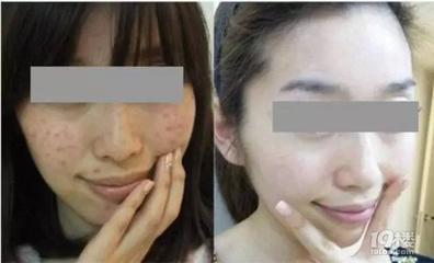 化妆脸上长痘痘吗