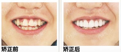 矫正牙齿前后