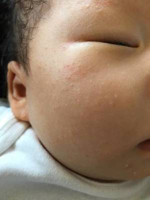 6个月宝宝出疹子症状