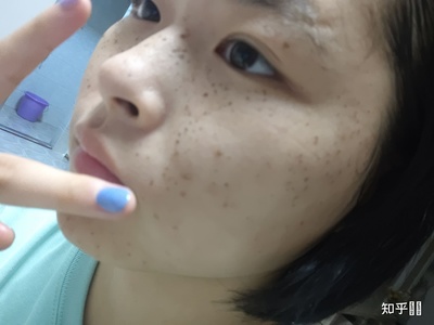 上海九院激光祛斑价格