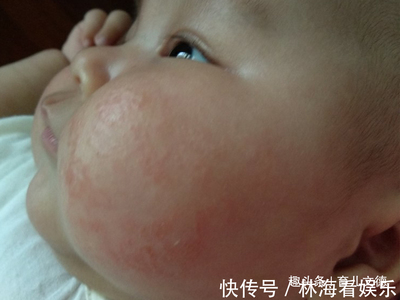 宝宝皮肤湿疹