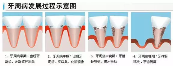 牙齿咬东西酸软无力怎么治疗