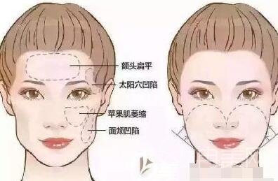 脸部填充脂肪的副作用