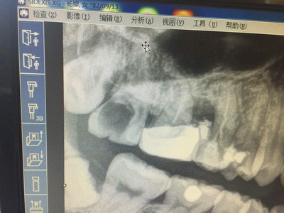 牙科rct是什么意思