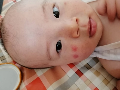 5个月宝宝脸上长小红疙瘩