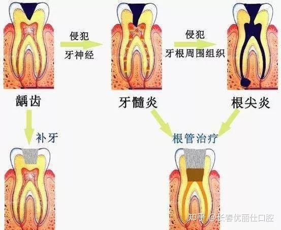 补牙后牙疼吃什么药