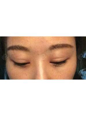 双眼皮割深了