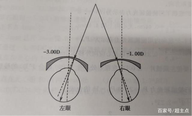 三棱镜100度是多少斜视