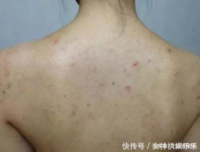 后背全身起痘痘是怎么回事