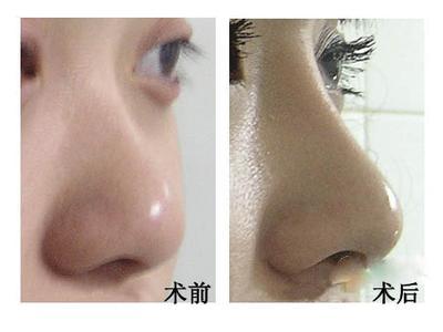 纳米隆鼻多少钱