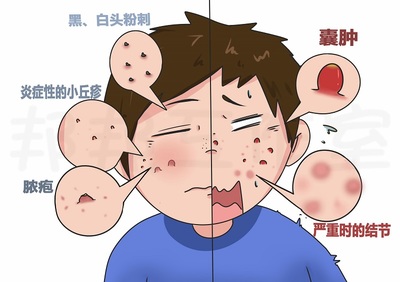 囊肿痤疮怎么治疗