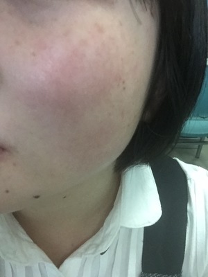 脸经常红是怎么回事