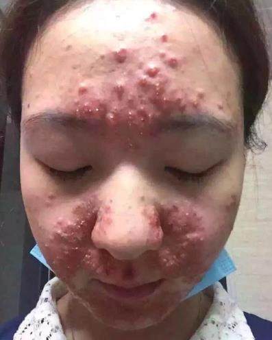 一个痘痘的生长周期