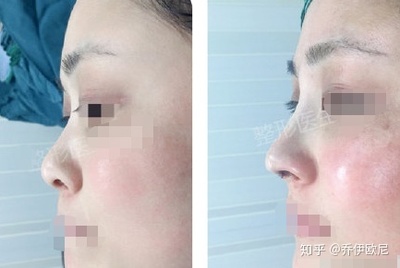 隆鼻等老了以后后遗症