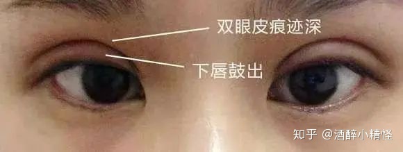 双眼皮割深了