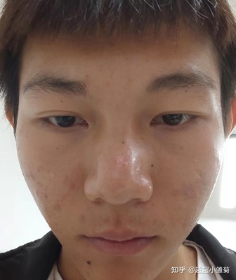 男生脸上的痘痘