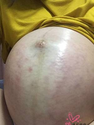 怀孕没有妊娠纹