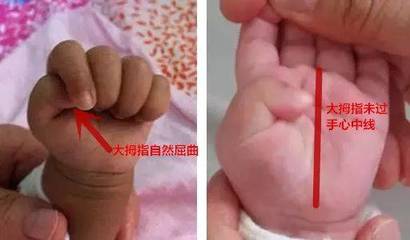 一岁宝宝拇指内扣