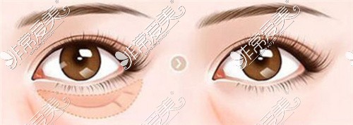 南京华美去眼袋怎么样