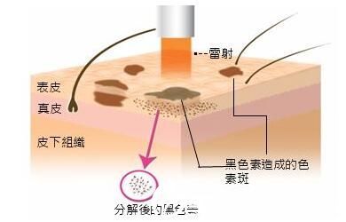 激光祛斑有疤吗