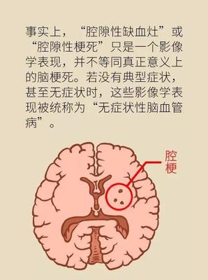 脑梗是怎么回事