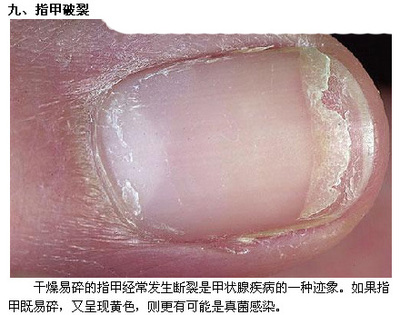 指甲破裂是怎么回事