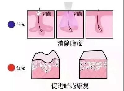 蓝光祛痘原理