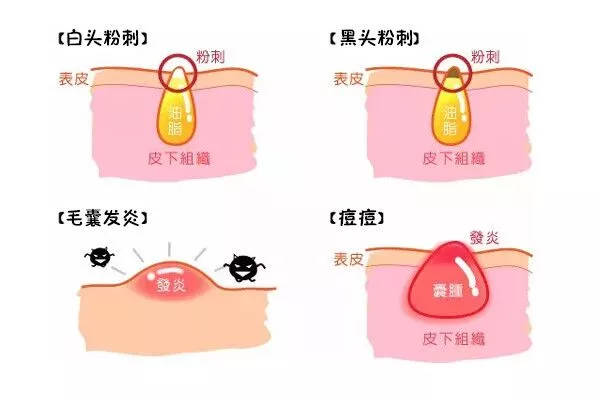 黑头粉刺怎么形成的