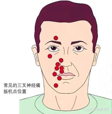 三叉神经疼是怎么回事
