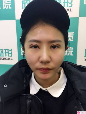 半岛整形双眼皮