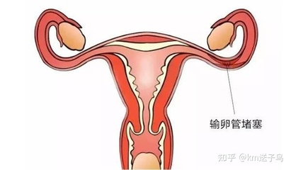 输卵管一边堵塞一边通会怀孕吗