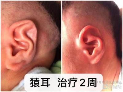 新生儿外耳畸形