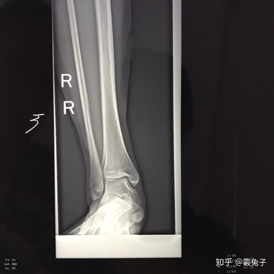 副舟骨怎么治疗最好