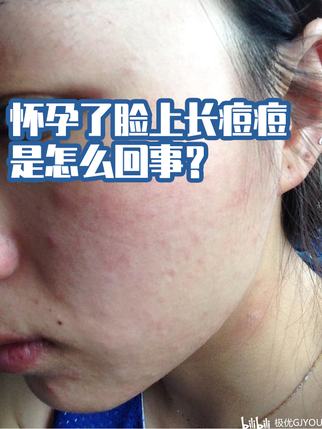 怀孕期间长痘痘