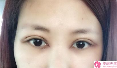 开眼角眼睛会变大吗