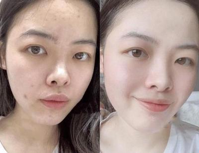 脸上有小的肤色痘痘