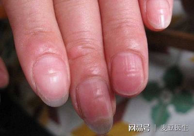 指甲上有黑纹是怎么回事