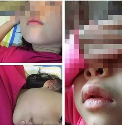 幼儿晚上流鼻血是怎么回事