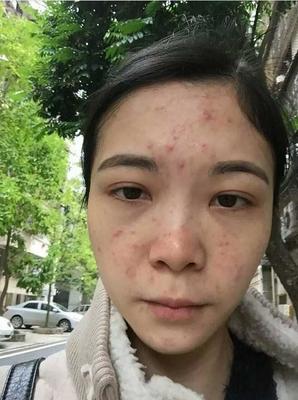 30岁痘痘一脸